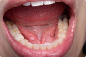 Dental Implant - After