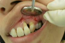 gum surgery