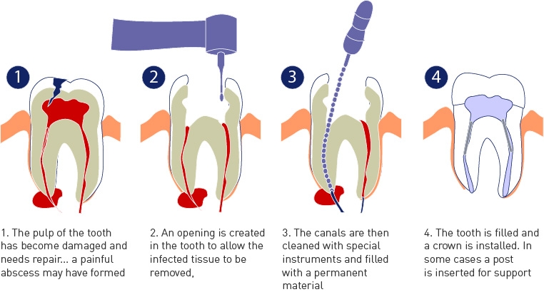 Root Canal Therapy (RCT)